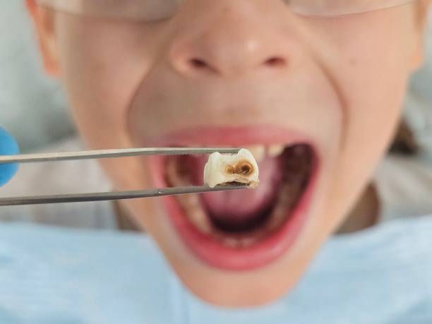 Best Urgent Care for Lost Fillings or Crowns in Swedesboro, NJ